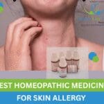 Best homeopathy remedies for skin allergy and eczema