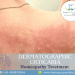 Dermatographic Urticaria
