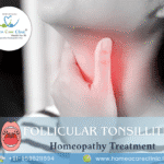 follicular tonsillitis treatment