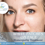 white patches on face